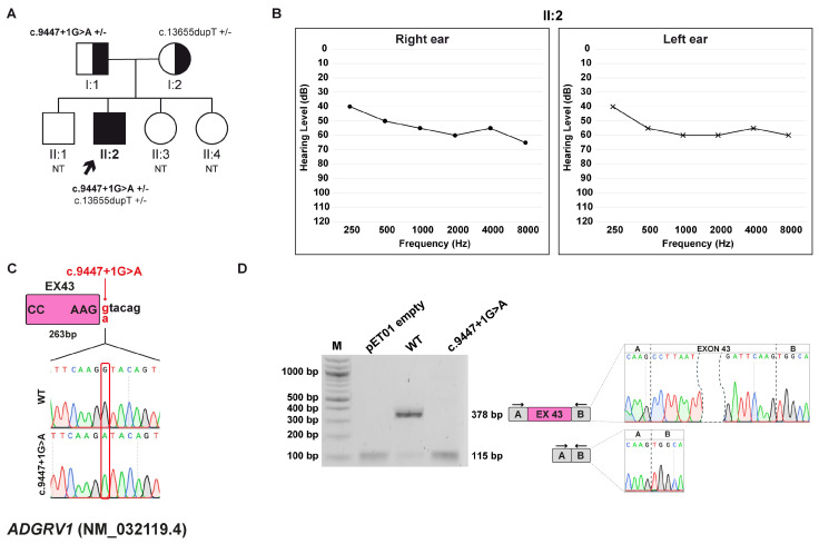Unraveling the Functional Impact of Splicing Variants in Inherited Hearing Disorders Through Minigene Splicing Assays.