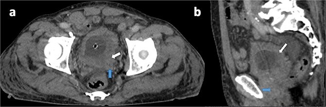 Malignant triton tumor of the bladder with fatal outcome: a rare case report.