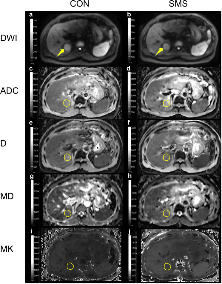 Performance of simultaneous multislice diffusion-weighted imaging using monoexponential, intravoxel incoherent motion, and diffusion kurtosis models: assessment of microvascular invasion and histologic grade in hepatocellular carcinoma.