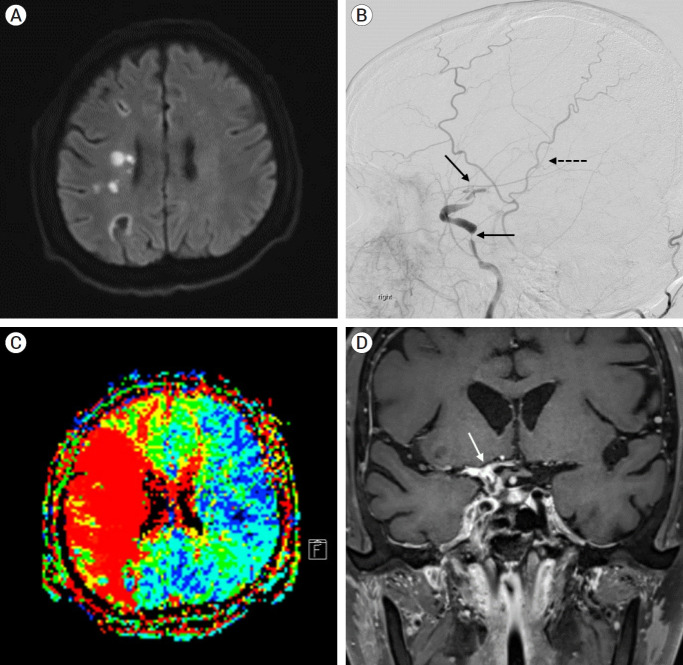 Superficial temporal artery-middle cerebral artery bypass for progressive cerebral infarction in invasive aspergillosis-induced total occlusion of internal carotid artery: A rare case and literature review.