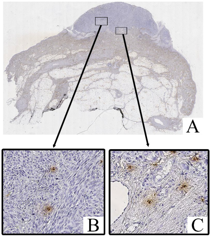 Phenotypic and Quantitative Characterization of Mast Cells in Cutaneous Melanoma: Correlation with Staging Metrics.