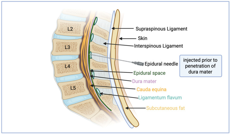 Pericapsular Nerve Group Block Versus Lumbar Epidural Block for Pain Management After Hip Surgeries with a Focus on Pediatric Patients: A Narrative Review.