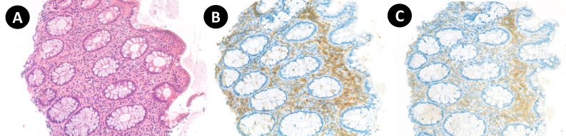 Aggressive systemic mastocytosis: unraveling the mystery behind chronic diarrhea.