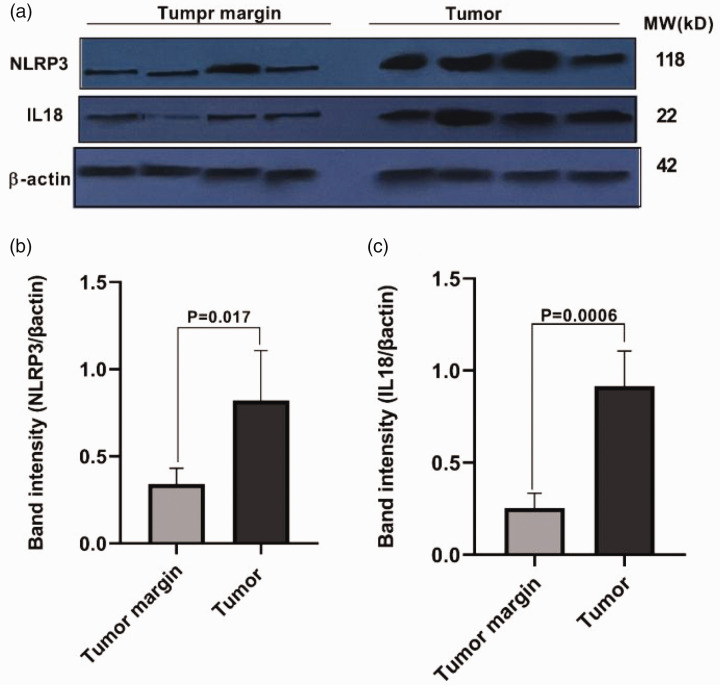 Expression analysis of NOD-like receptor protein 3 and interleukin-18 in basal cell carcinoma: A case-control study.