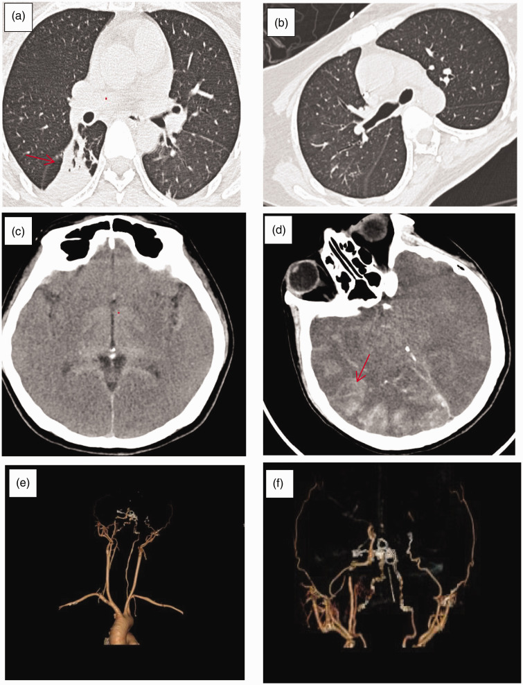 Death caused by transdermal ivermectin poisoning: A case report and literature review.