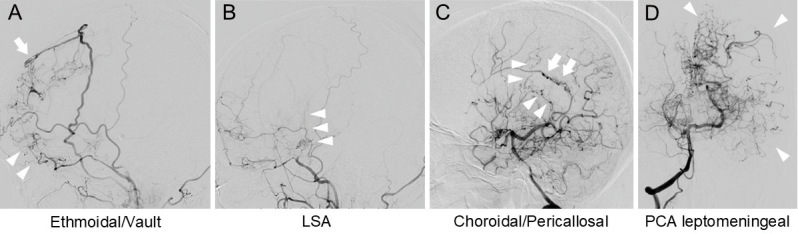 Incidence and Clinical Characteristics of Moyamoya Disease in Advanced Suzuki Disease Stages.