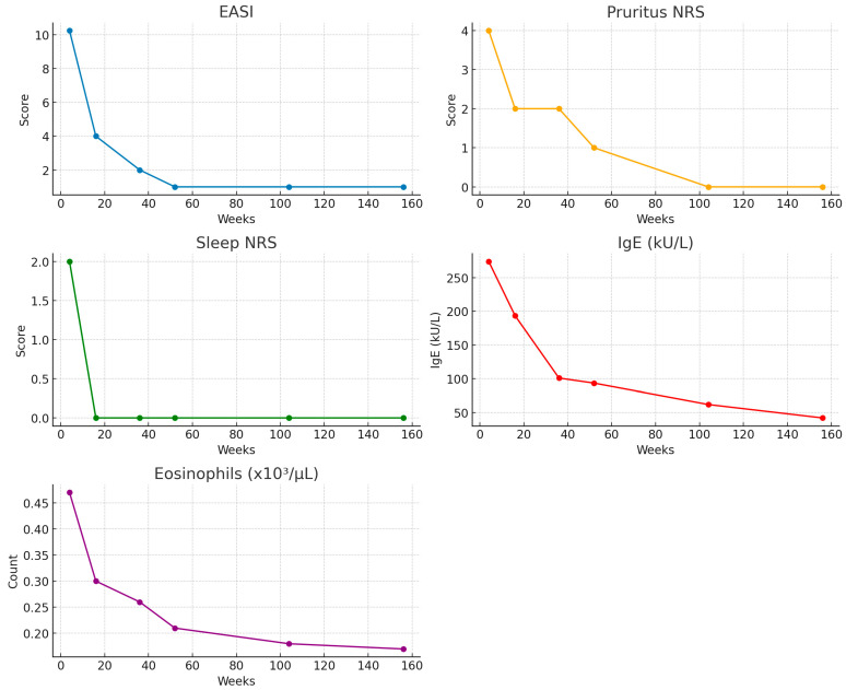 Safety and Effectiveness of Dupilumab in Atopic Dermatitis Patients with Hematologic Comorbidities: A Multicenter, Retrospective Study.