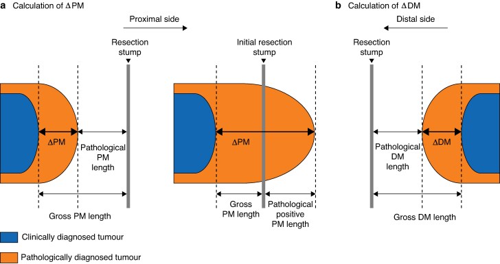 Oncological impact of unexpected horizontal tumour spread in oesophagogastric junction cancer.