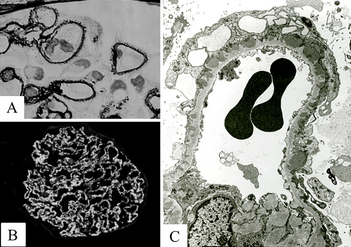 Randomized Prospective Controlled Open-labeled Trial of Cyclosporine with/without Low-dose Oral Corticosteroids in Idiopathic Membranous Nephropathy in Adults with Nephrotic Syndrome.