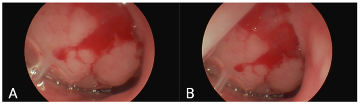 Evaluation of Oral Health and Oral Health-Related Quality of Life in Children with Adenoid Hypertrophy.