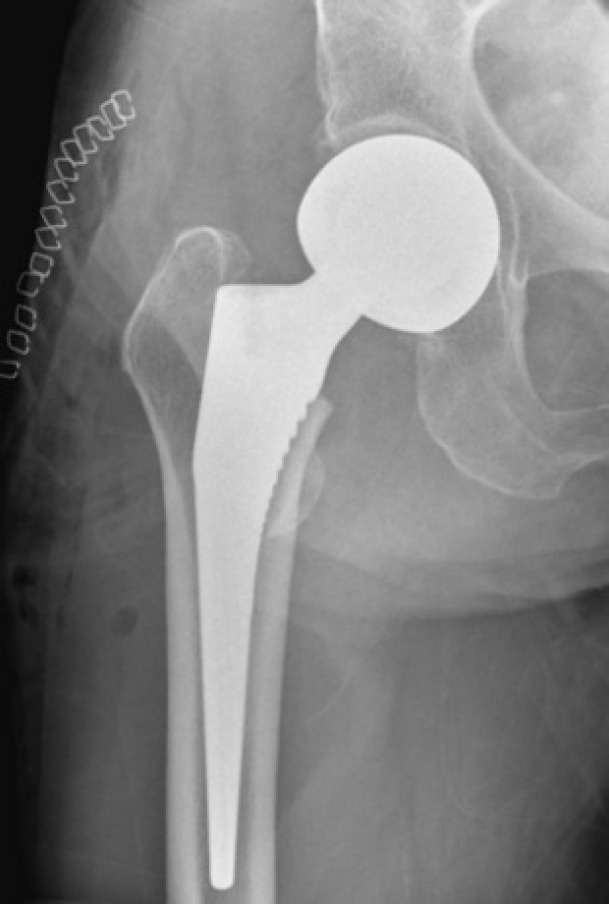 The SPAIRE (saving piriformis and internus, repair of externus) posterolateral approach in bipolar hemiarthroplasty for femoral neck fractures: a case report.