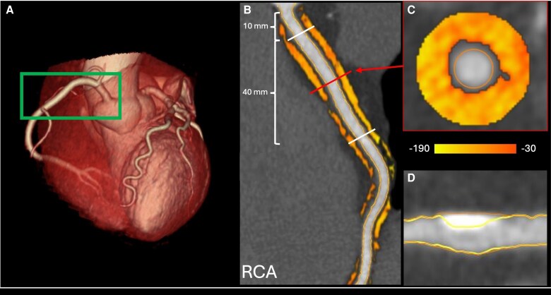 Association between inflammatory biomarkers, chronic stress, and pericoronary adipose tissue attenuation obtained with coronary CT.