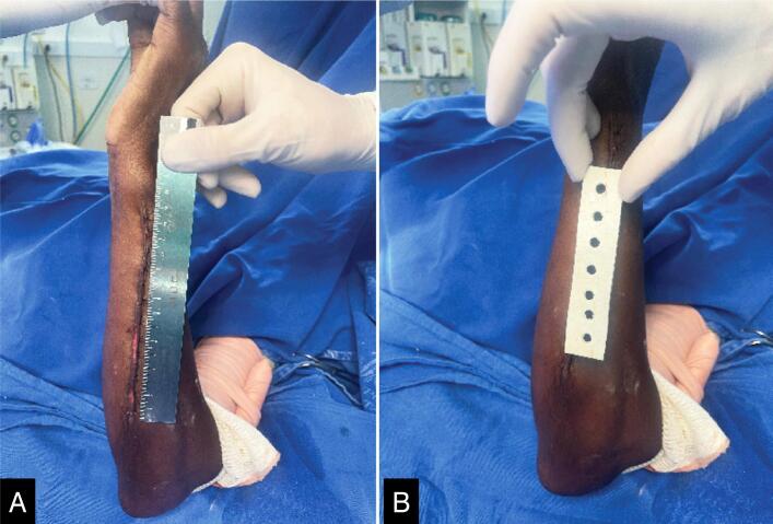 VANCOMYCIN- AND CHLORHEXIDINE DIGLUCONATE-IMPREGNATED DRESSING FOR THE PREVENTION OF ORTHOPEDIC SURGICAL SITE INFECTIONS: A PILOT STUDY USING A LOW-COST PROCEDURE.