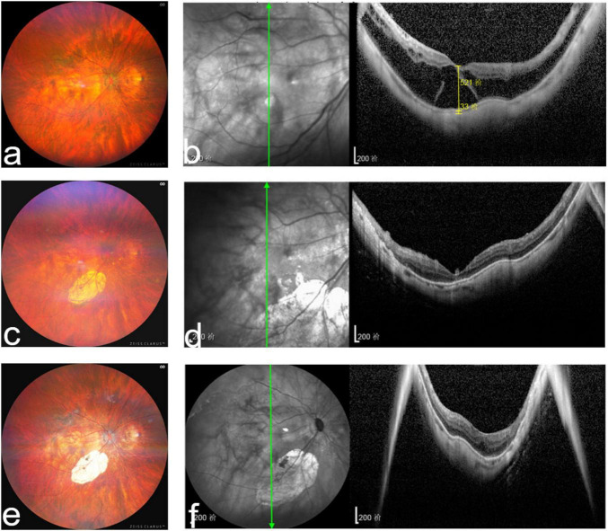 Comparison of the effectiveness of vitrectomy with silicone oil or perfluoropropane tamponade for myopic foveoschisis with foveal detachment.