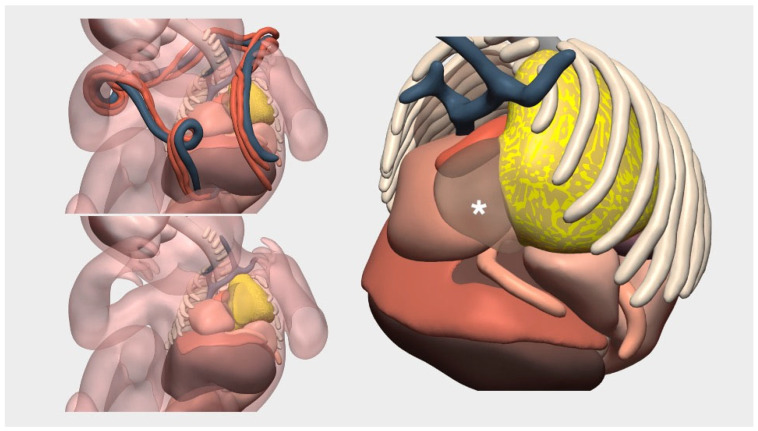 Clinical Impact of Patient-Specific 3D Models in Neonatal Surgery: A Case-Based Review of Applications and Future Directions.