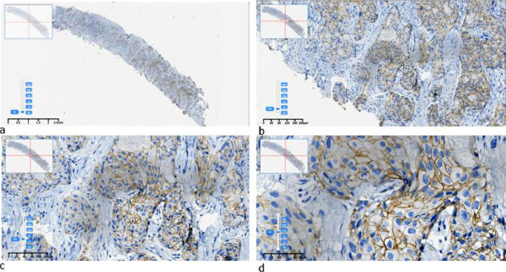 Kazakhstani HER2 breast cancer digital image dataset: The ADEL dataset.