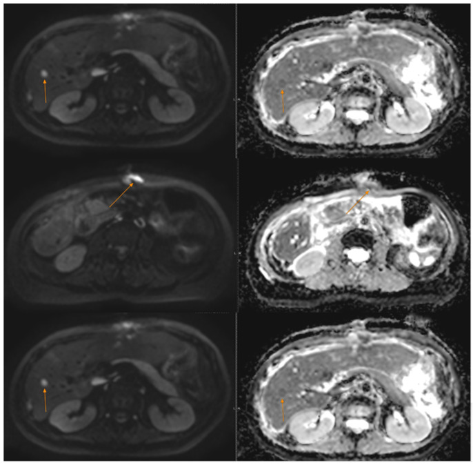 The Role of Targeted Therapy and Immunotherapy in Metastatic GNET/Clear Cell Sarcoma (CCS) of the Gastrointestinal Tract: A Case Report.