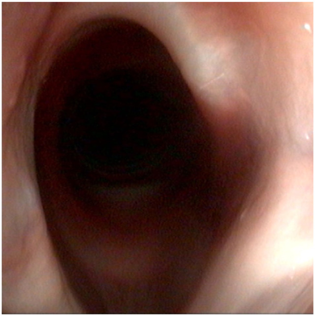 Effect of unilateral arytenoid lateralisation on the rima glottidis volume in cats: a cadaveric study.