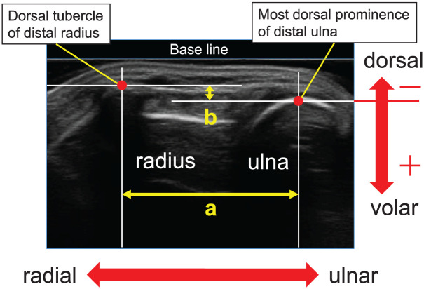 Distal Radioulnar Joint Kinematics Evaluated Using Ultrasonography During Handstanding in Female Gymnasts.