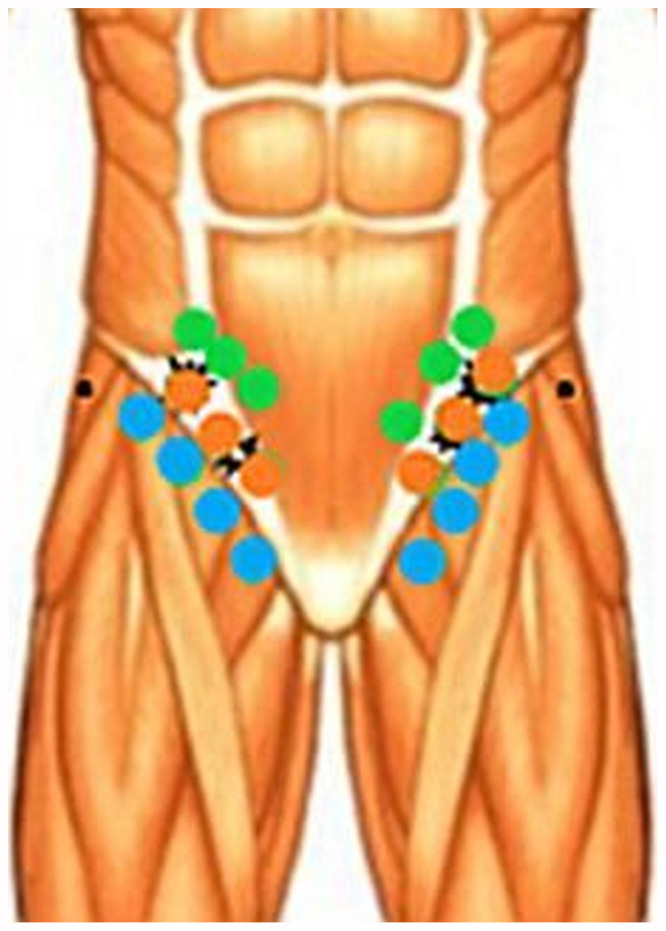 Clinical Improvement in a Case of Alternating Hemiplegia of Childhood After Cerebral Lymphatic Drainage.