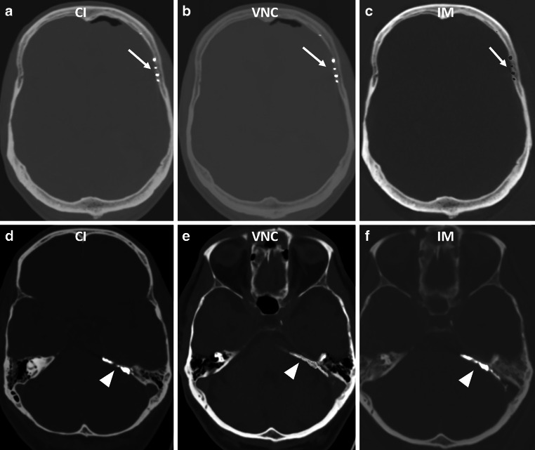 In Vivo Discrimination of Iodine and Tantalum-Based Liquid Embolics After Intracranial or Spinal Embolization Using Photon-Counting Detector CT.