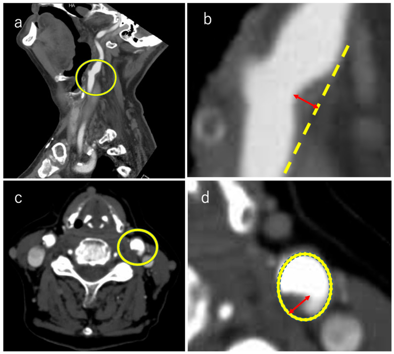 Association Between Carotid Artery Small Plaque on Computed Tomography Angiography and Embolic Stroke of Undetermined Source.