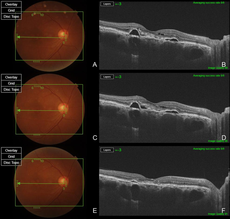 Efficacy of Intravitreal Brolucizumab for Chronic Central Serous Chorioretinopathy: A Pilot Study.