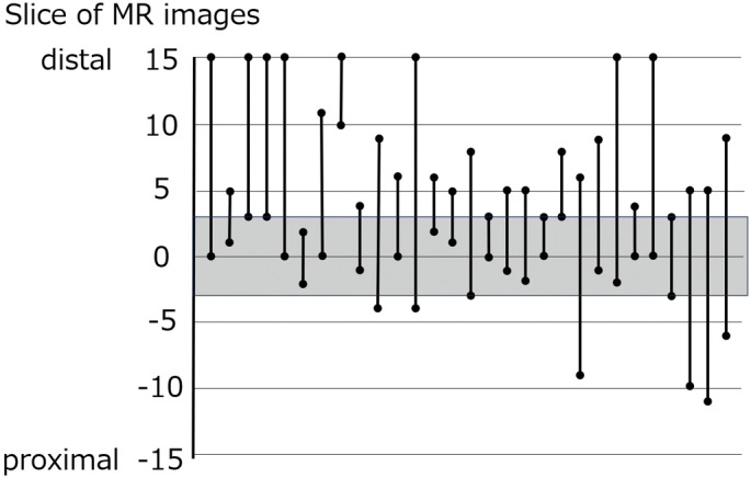 Preoperative Magnetic Resonance Imaging Findings in Patients with Tarsal Tunnel Syndrome and Postoperative Outcomes.