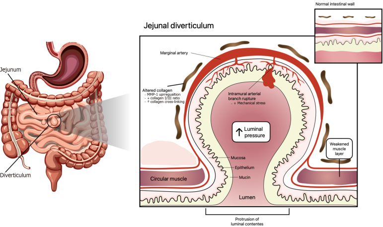 Jejunal diverticular disease: A gastrointestinal bleeding enigma.