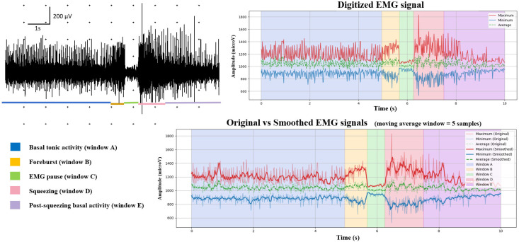 Unilateral EMG-Guided Botulinum Toxin for Retrograde Cricopharyngeus Dysfunction: A Prospective Clinical and Neurophysiological Study.