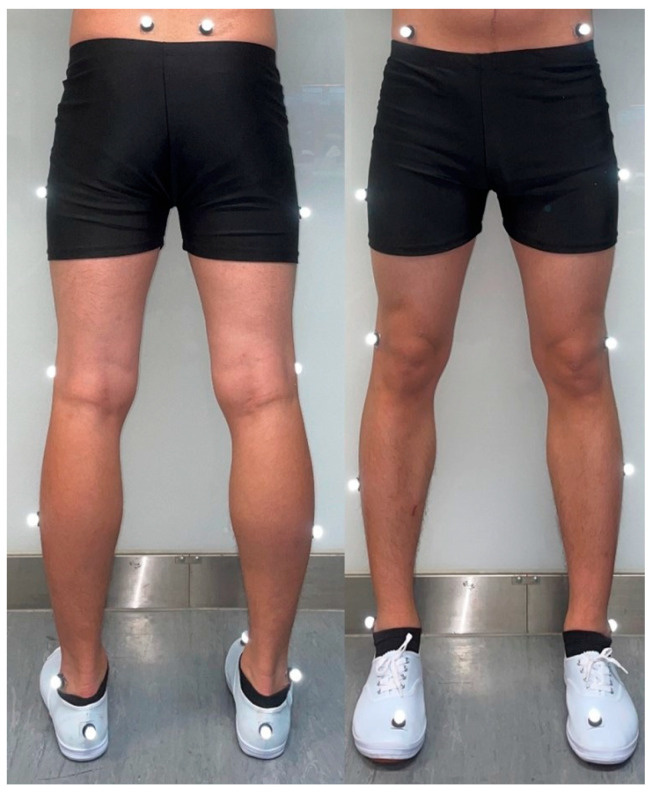 Effects of Arch Support Pad Stiffness on Lower-Limb Biomechanics During Single-Leg Landing.