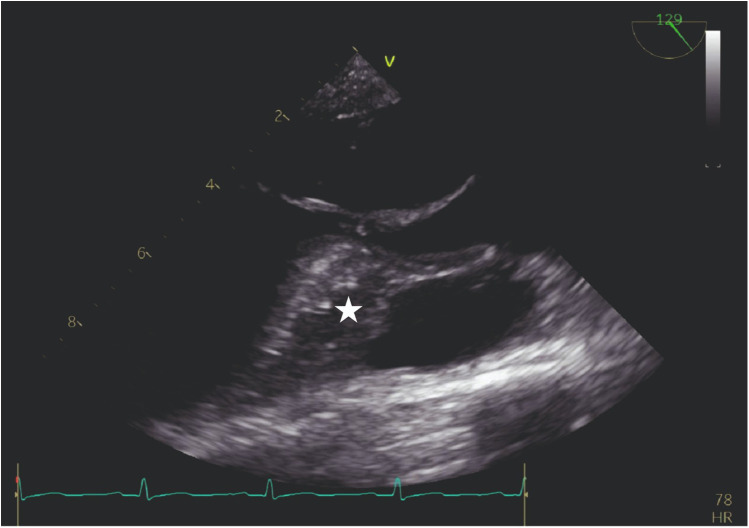 Contrast echocardiography with a physiological contrast agent for alcohol septal ablation.