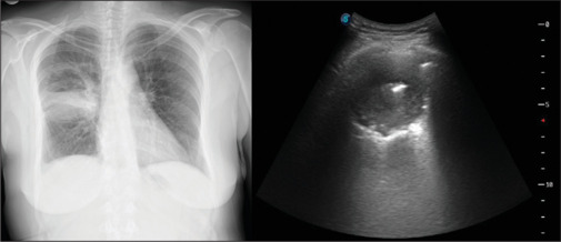 Thoracic ultrasonography in the diagnosis and follow-up of lung abscess.