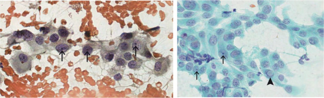 In suspicious for malignancy thyroid nodule aspirates, nuclei characteristics deserves special attention in reported cytology analysis - real world scenario cohort.