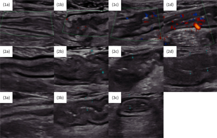 IBUS-SAS Is a Highly Accurate Intestinal Ultrasound Score for Predicting Endoscopic Disease Activity in Ulcerative Colitis.