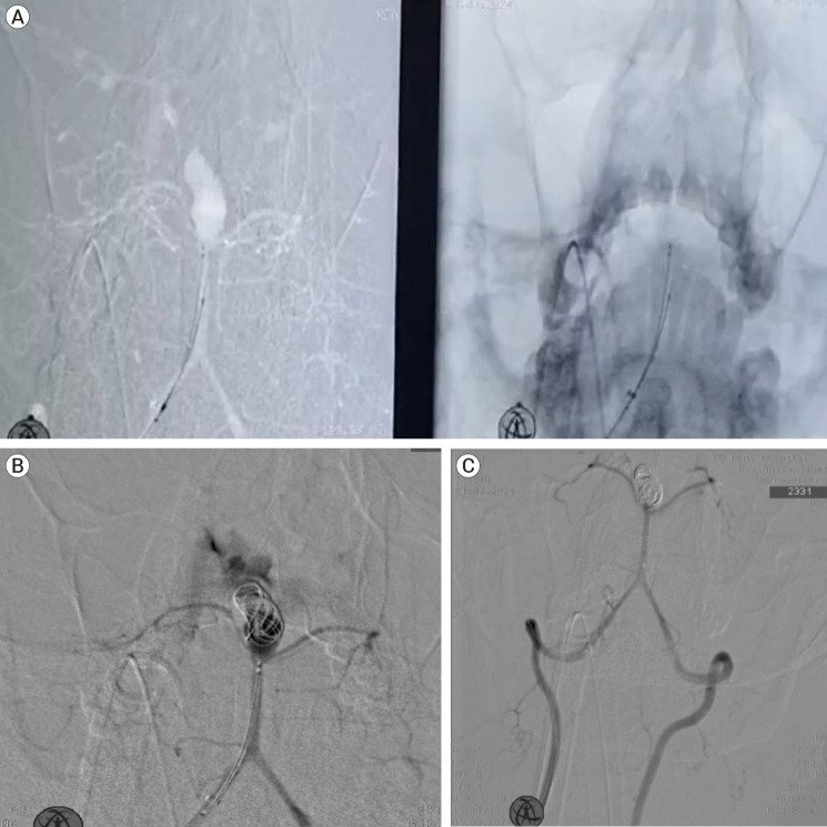 A rare case of Fahr's disease with posterior circulation (basilar tip) aneurysm- pathophysiology, management, and complications.