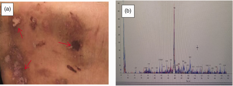 Death caused by transdermal ivermectin poisoning: A case report and literature review.