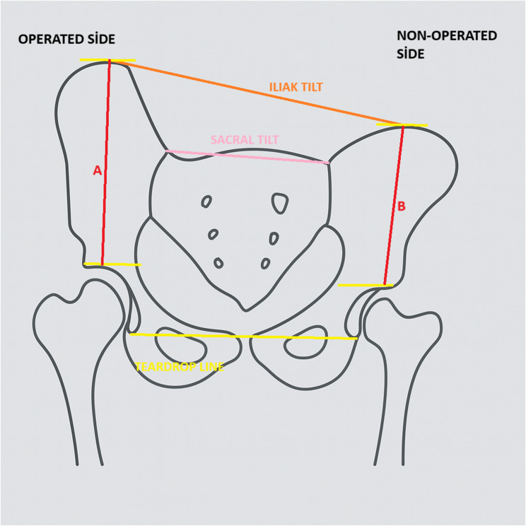 Comparative evaluation of long-term spinopelvic morphology after salter and pemberton osteotomies in DDH patients: follow-up of 8 years.