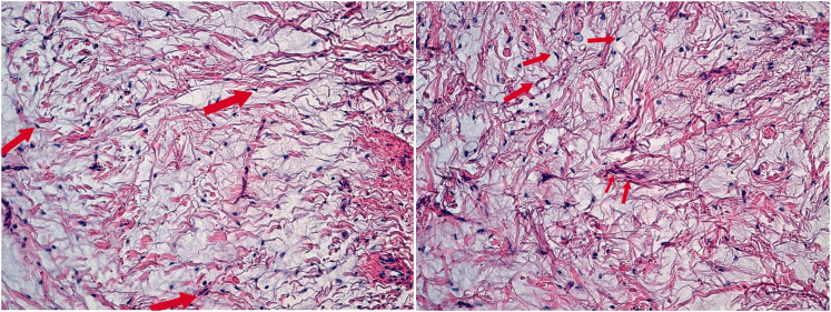 A case report of desmoplastic fibroblastoma in a 2-year-old child.