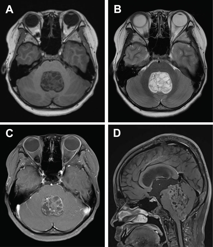 Central nervous system tumors with BCOR internal tandem duplications: a systematic review of clinical, radiological, and pathological features in 69 cases.