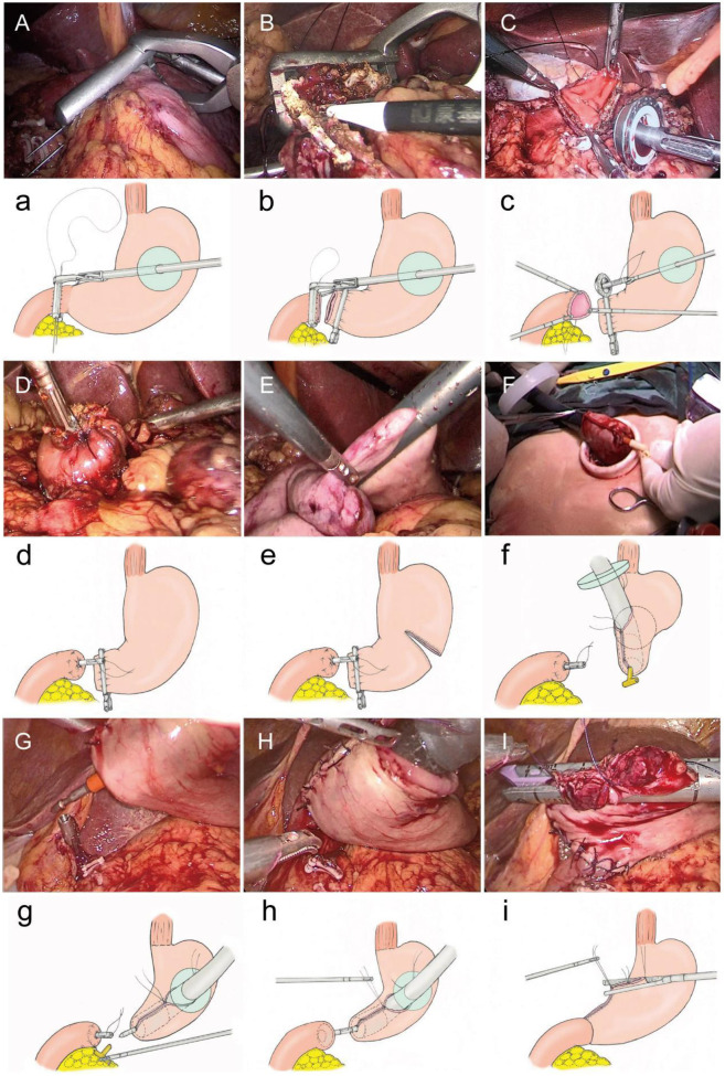 Intracorporeal circular-stapled gastroduodenostomy for billroth I reconstruction in total laparoscopic distal gastrectomy.