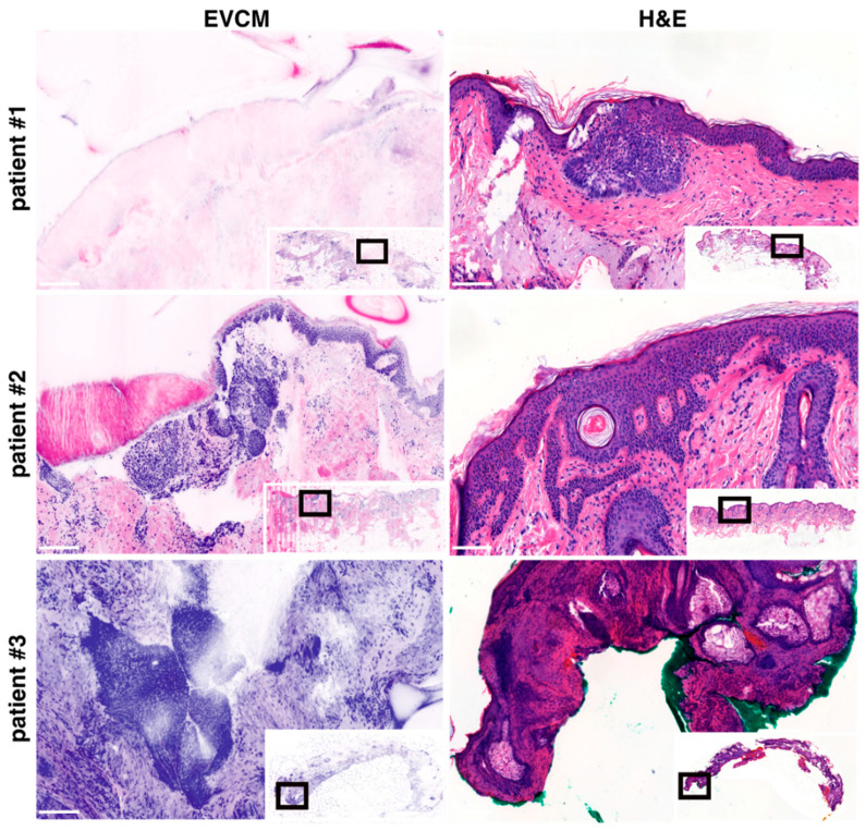 Diagnostic Accuracy of Ex Vivo Confocal Microscopy for Surgical Margin Assessment of High-Risk Nodular Basal Cell Carcinoma.