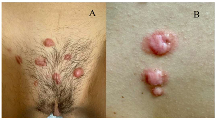 Recent Progress in Keloid Mechanism and Treatment: A Comprehensive Review.