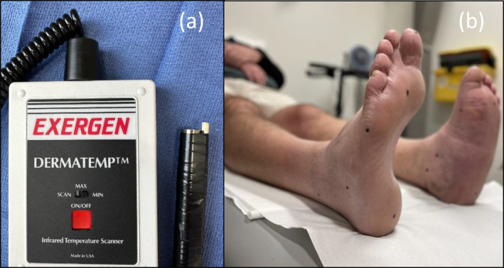 Optimal Time Period to Achieve Temperature Stabilisation After Total Contact Cast (TCC) Removal for Assessing Dermal Temperatures in Active Charcot Neuro-Osteoarthropathy.