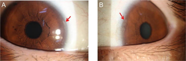Immune-Related Peripheral Keratopathy in Post-COVID-19 Syndrome.