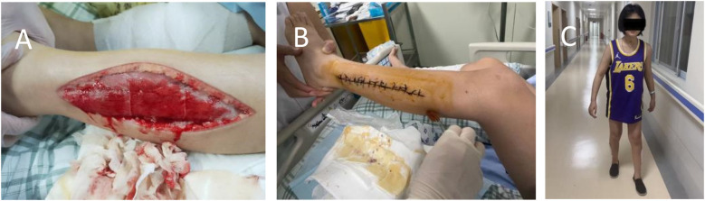 Case Report: A rare case of acute herbicide poisoning induced pediatric acute osteofascial compartment syndrome.