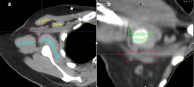 Lymphedema and Axillary-Lateral Thoracic Vessel Juncture Irradiation: A Clinical Dilemma.