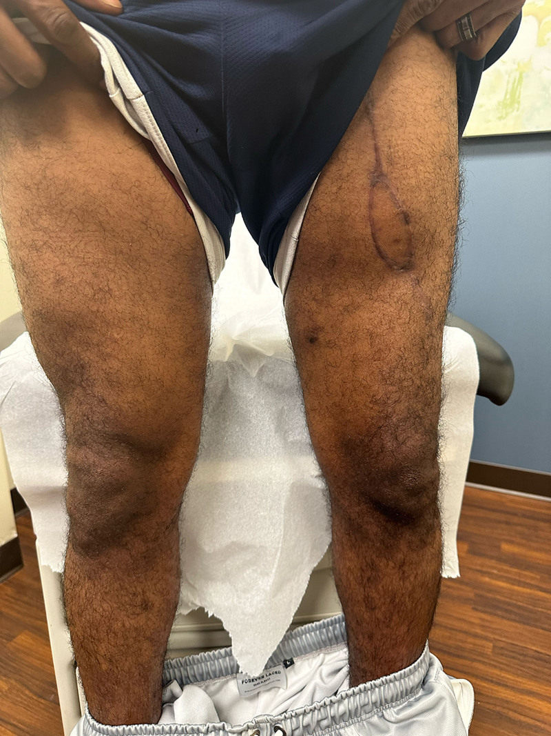 Novel Split Latissimus Dorsi Myocutaneous Flap After High-velocity Ballistic Injury With Functional Deficit: Retrospective Case Series.