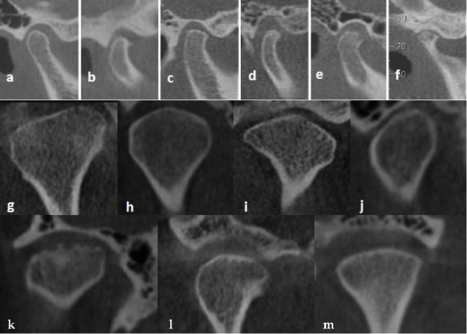 The Combined Impact on Condylar Changes of Sex and Cortication on Mandibular Condyle: A Binary Logistic Regression Analysis.