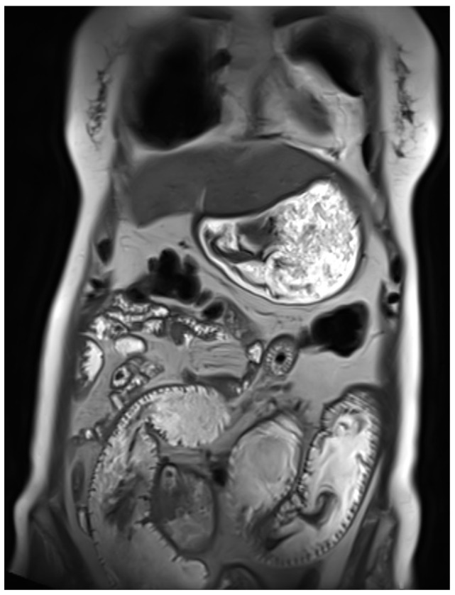 The Role of Targeted Therapy and Immunotherapy in Metastatic GNET/Clear Cell Sarcoma (CCS) of the Gastrointestinal Tract: A Case Report.